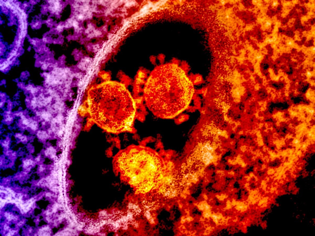 First Human Death Linked to Livestock-Borne Shamonda Virus Reported in France